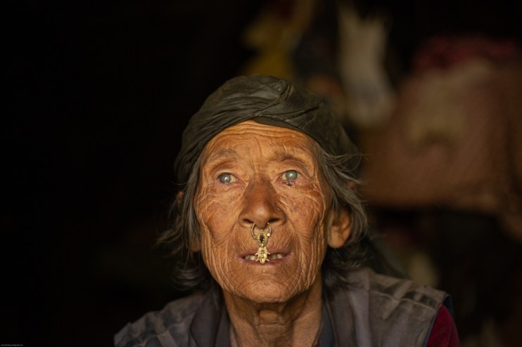Shri Mani suffering with cataracts