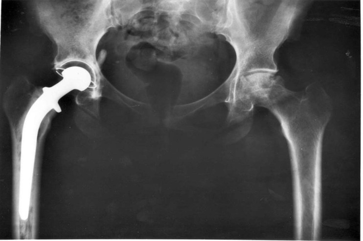 Smith & Nephew is one of the world's largest hip replacement manufacturers