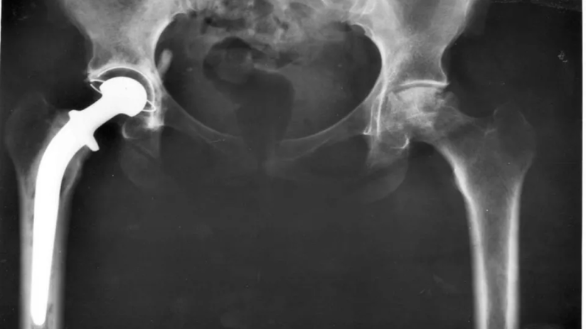 Smith & Newphew is one of the world&rsquo;s largest hip replacement manufacturers.